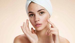 Trị mụn bằng bột nghệ